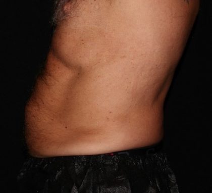 Abdomen Before & After Patient #1543
