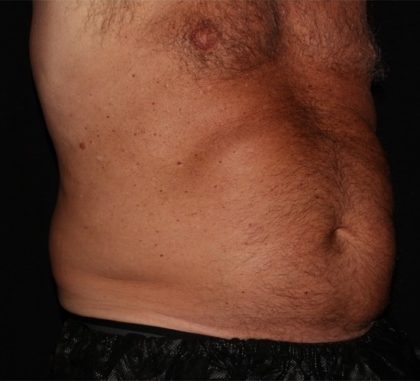 Abdomen Before & After Patient #1543