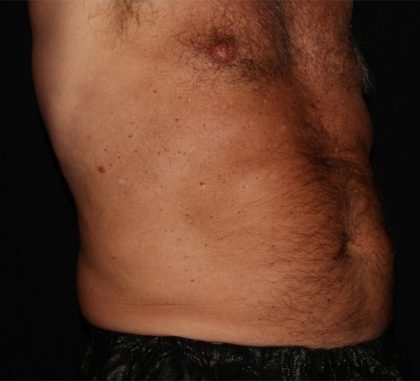 Abdomen Before & After Patient #1543
