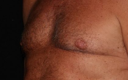 Male Chest Before & After Patient #1578