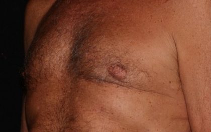 Male Chest Before & After Patient #1578