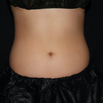 Abdomen Before & After Patient #1645
