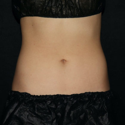 Abdomen Before & After Patient #1645