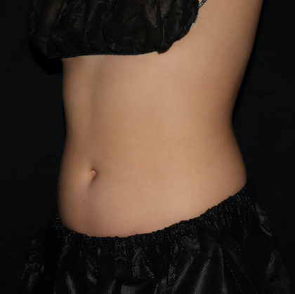 Abdomen Before & After Patient #1645