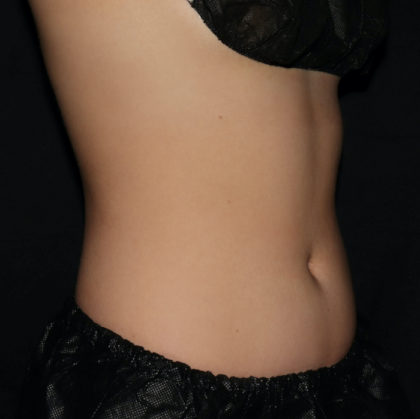 Abdomen Before & After Patient #1645