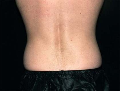 Flank / Side Before & After Patient #1690