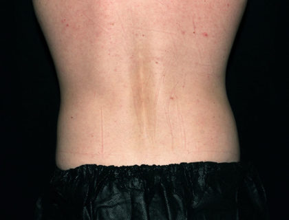 Flank / Side Before & After Patient #1690