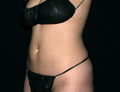Abdomen Before & After Patient #1698