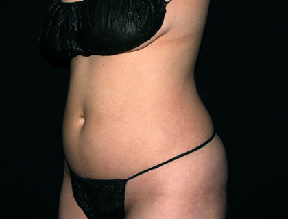 Abdomen Before & After Patient #1698