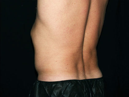 Flank / Side Before & After Patient #1693