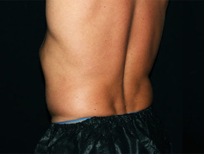 Flank / Side Before & After Patient #1693