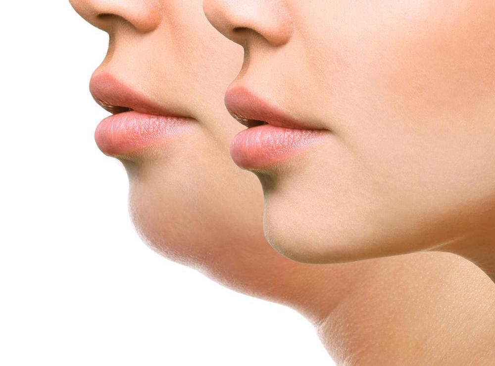 Top 8 coolsculpting chin before and after 2022