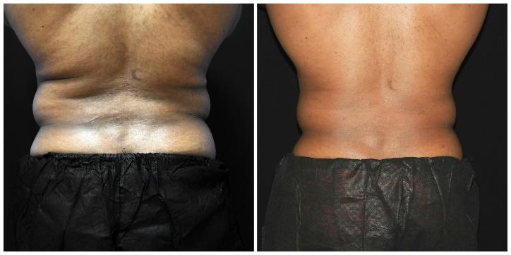 The 4 Best CoolSculpting Areas for Men DaVinci Body Sculpting