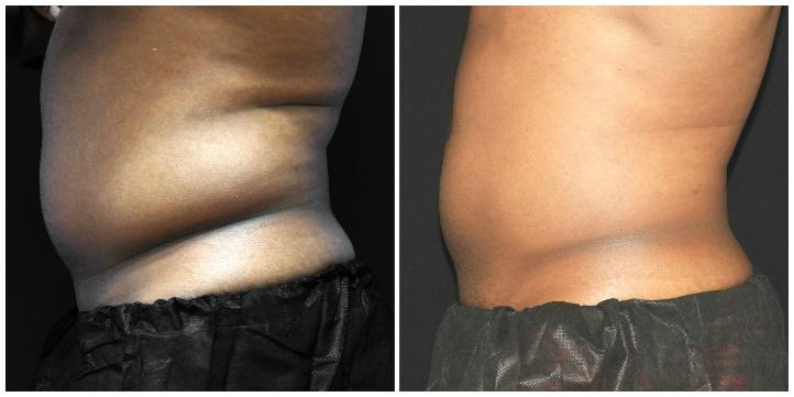 Coolsculpting men's love handles sale