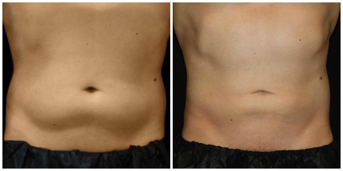 The 4 Best CoolSculpting Areas for Men