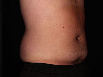 Flank / Side Before & After Patient #1832