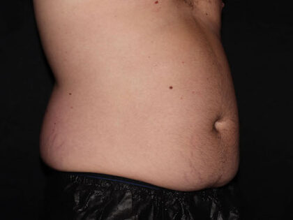 Flank / Side Before & After Patient #1832