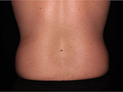 Flank / Side Before & After Patient #1832