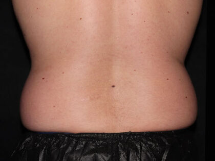 Flank / Side Before & After Patient #1832