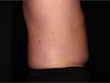 Flank / Side Before & After Patient #1832