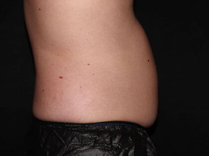Flank / Side Before & After Patient #1832
