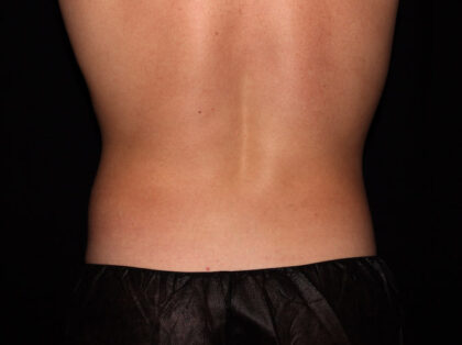 Flank / Side Before & After Patient #1867