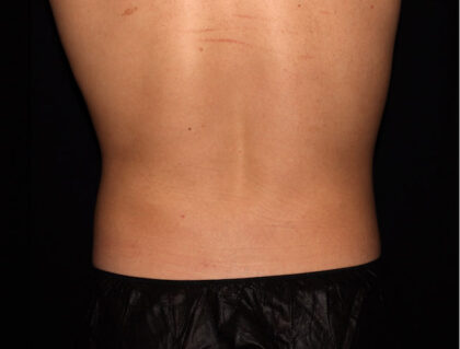Flank / Side Before & After Patient #1867
