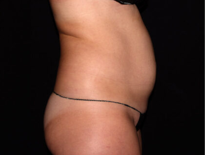 Abdomen Before & After Patient #1870