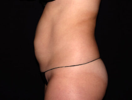 Abdomen Before & After Patient #1870