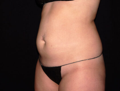 Abdomen Before & After Patient #1870