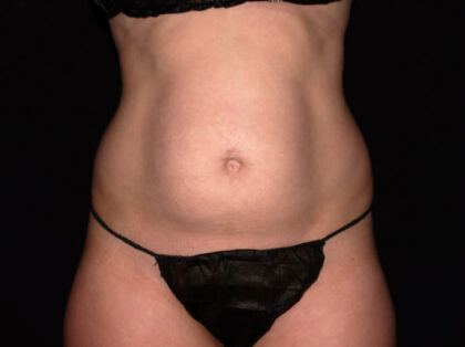 Abdomen Before & After Patient #1870
