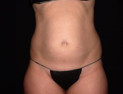 Abdomen Before & After Patient #1870