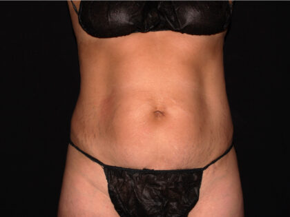 Abdomen Before & After Patient #1888