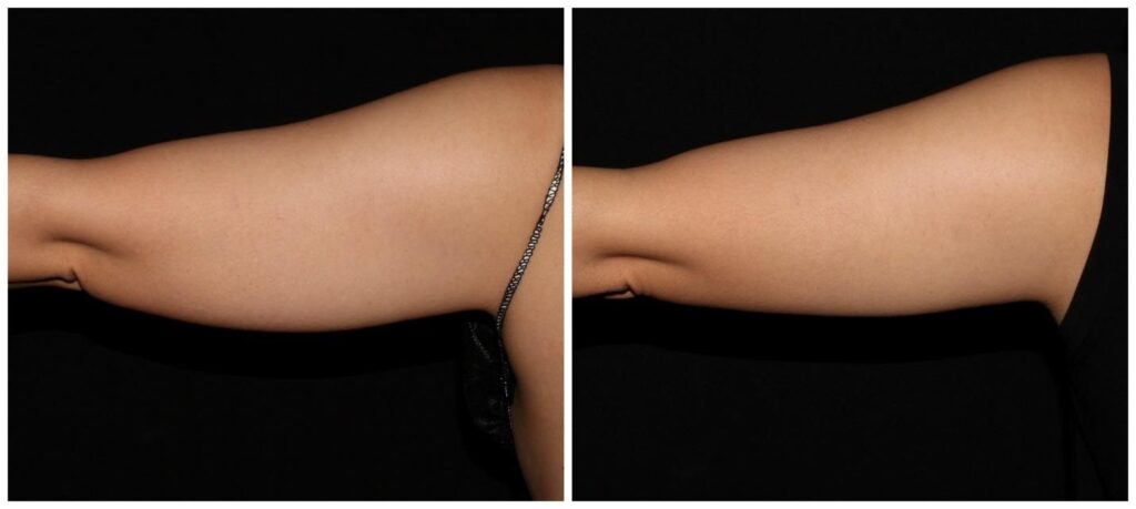 before and after coolsculpting