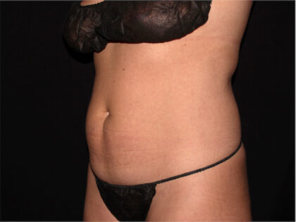 Abdomen Before & After Patient #1935