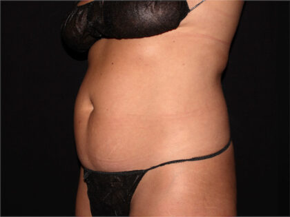 Abdomen Before & After Patient #1935