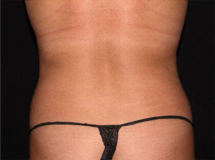 Flank / Side Before & After Patient #1941