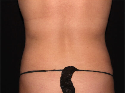 Flank / Side Before & After Patient #1941