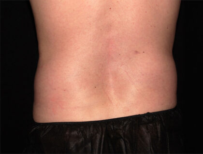 Flank / Side Before & After Patient #1927