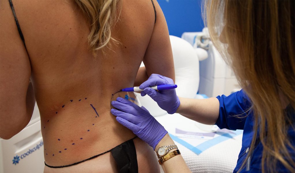 CoolSculpting Houston, TX