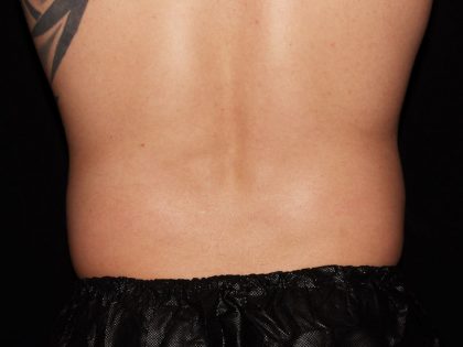 Flank / Side Before & After Patient #1960