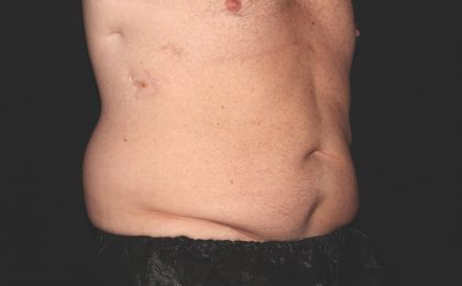 Flank / Side Before & After Patient #1955