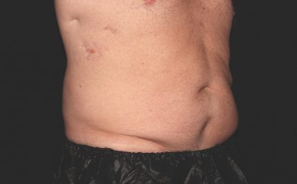 Flank / Side Before & After Patient #1955