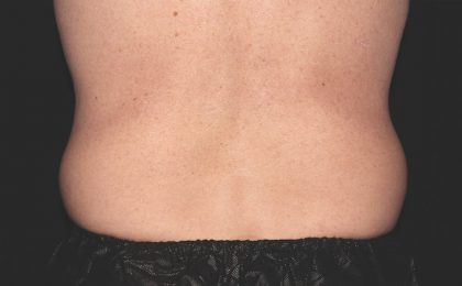 Flank / Side Before & After Patient #1955