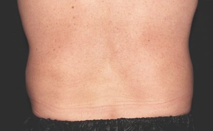 Flank / Side Before & After Patient #1955