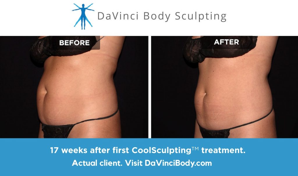 Types of Body Fat & How CoolSculpting Helps