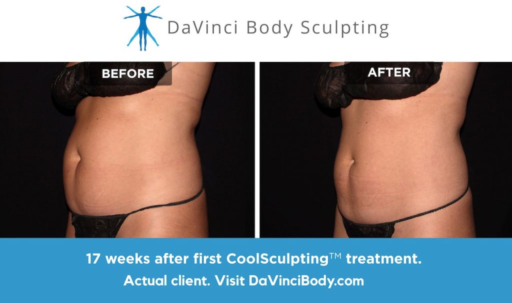 CoolSculpting Fat Reduction