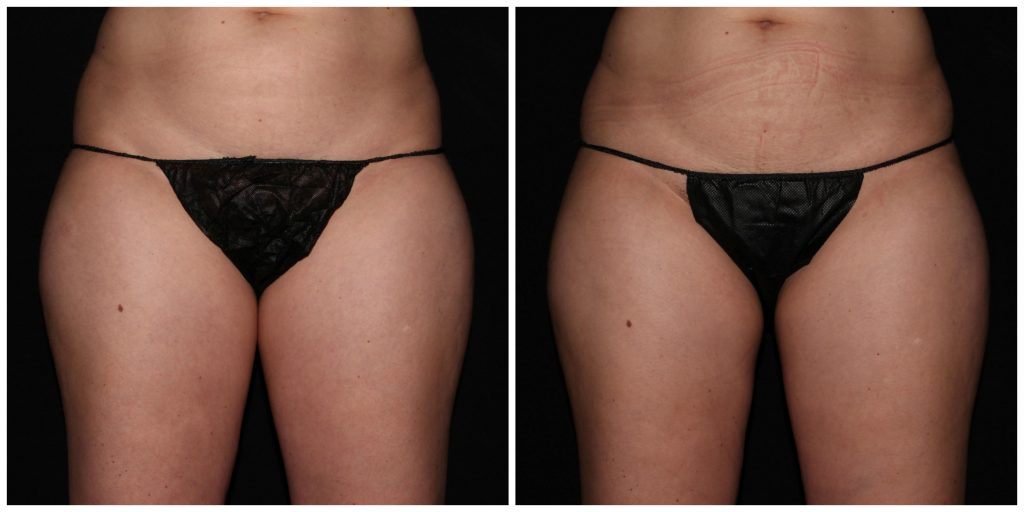 Get Rid of Thigh Chafing or “Chub Rub”