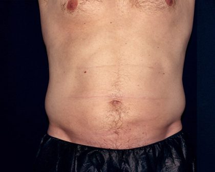 Flank / Side Before & After Patient #2056