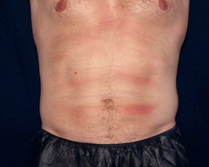Flank / Side Before & After Patient #2056
